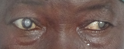 Des médecins soudanais au Gabon pour soigner des yeux malades